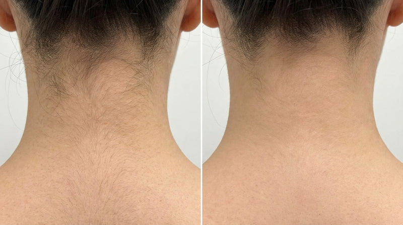Laser Hair Removal - Neck