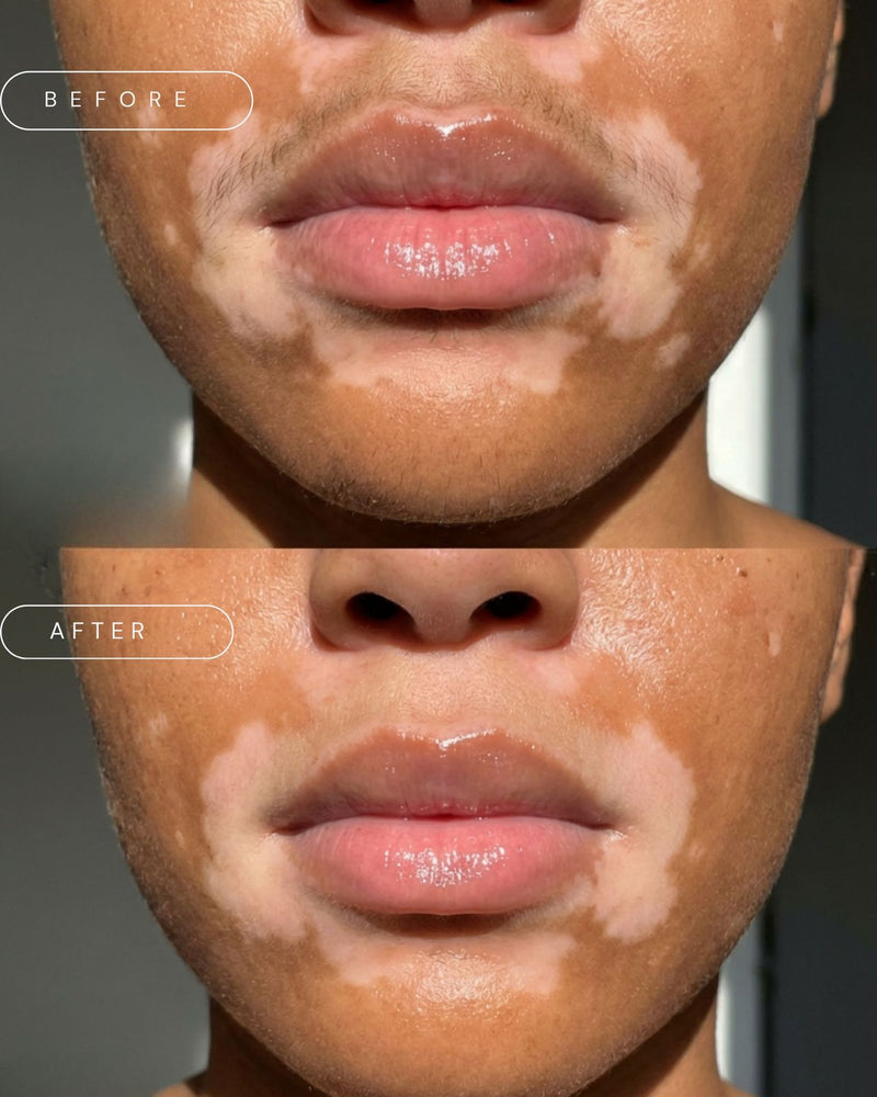 Laser Hair Removal - Upper Lip