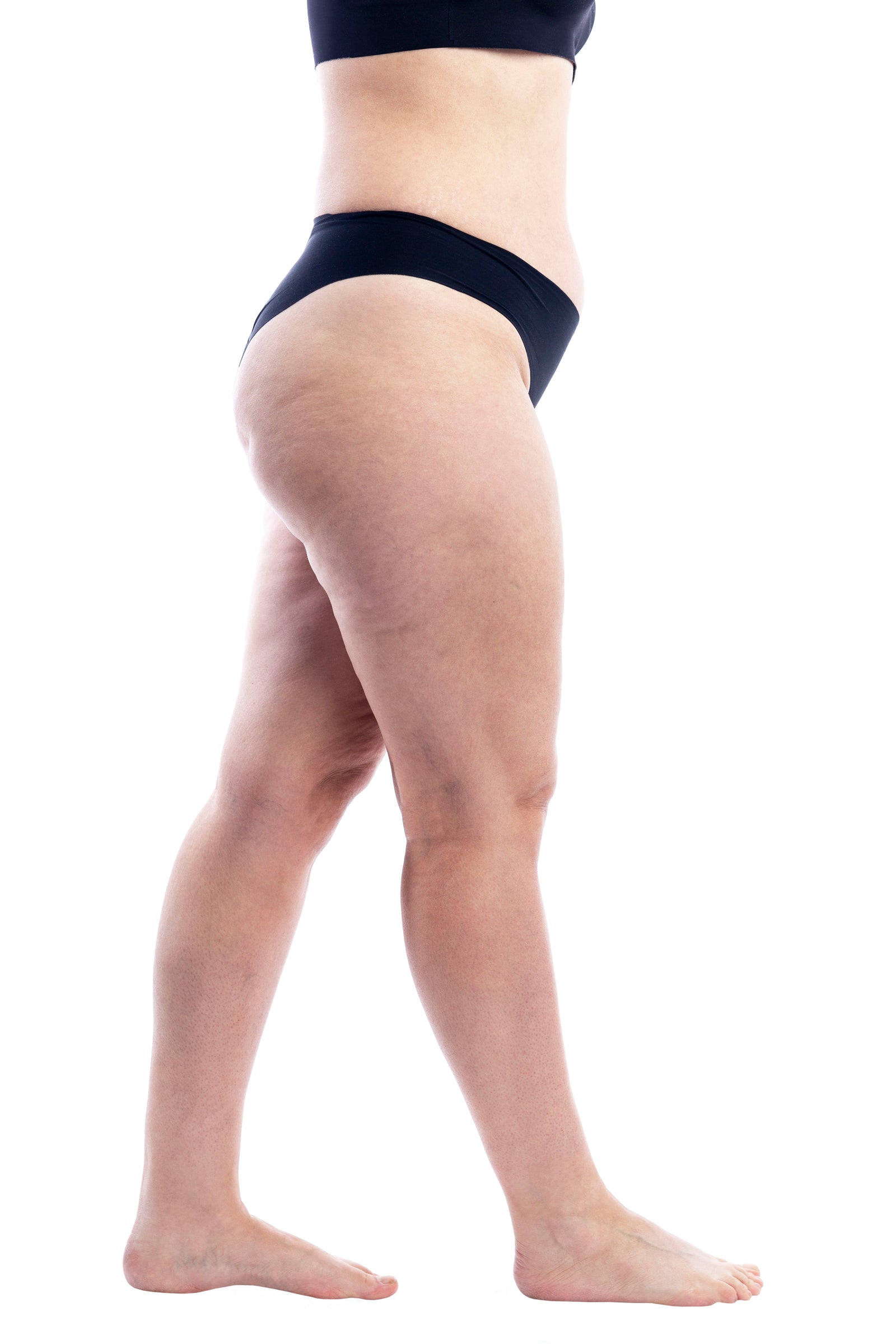 Laser Thread Veins Removal - 30 minutes - Idens Laser Clinic