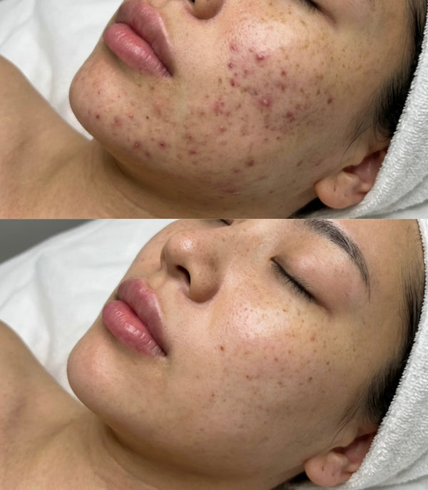 Clear & Glow Acne Treatment