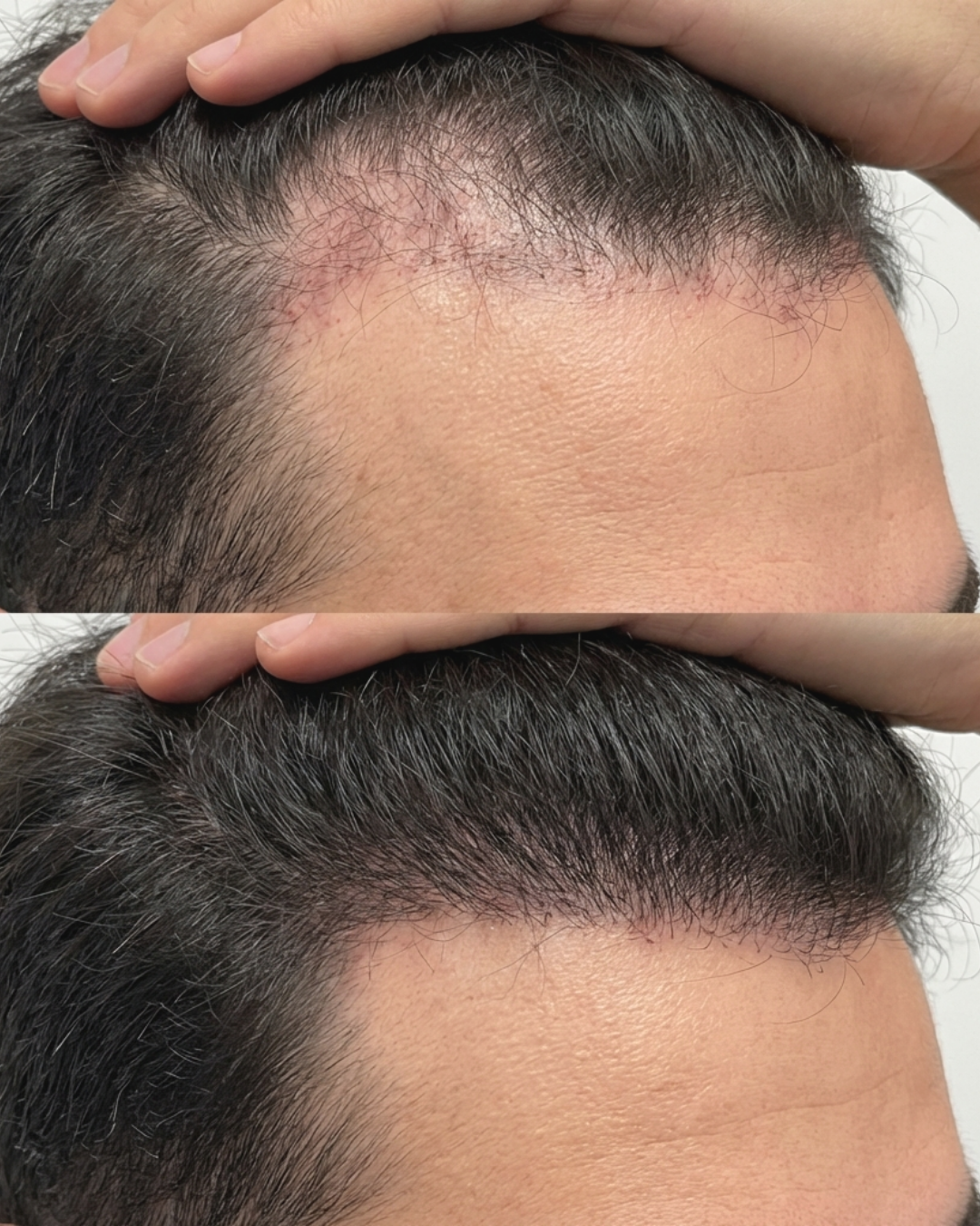 Hair Regrowth PRP Treatment