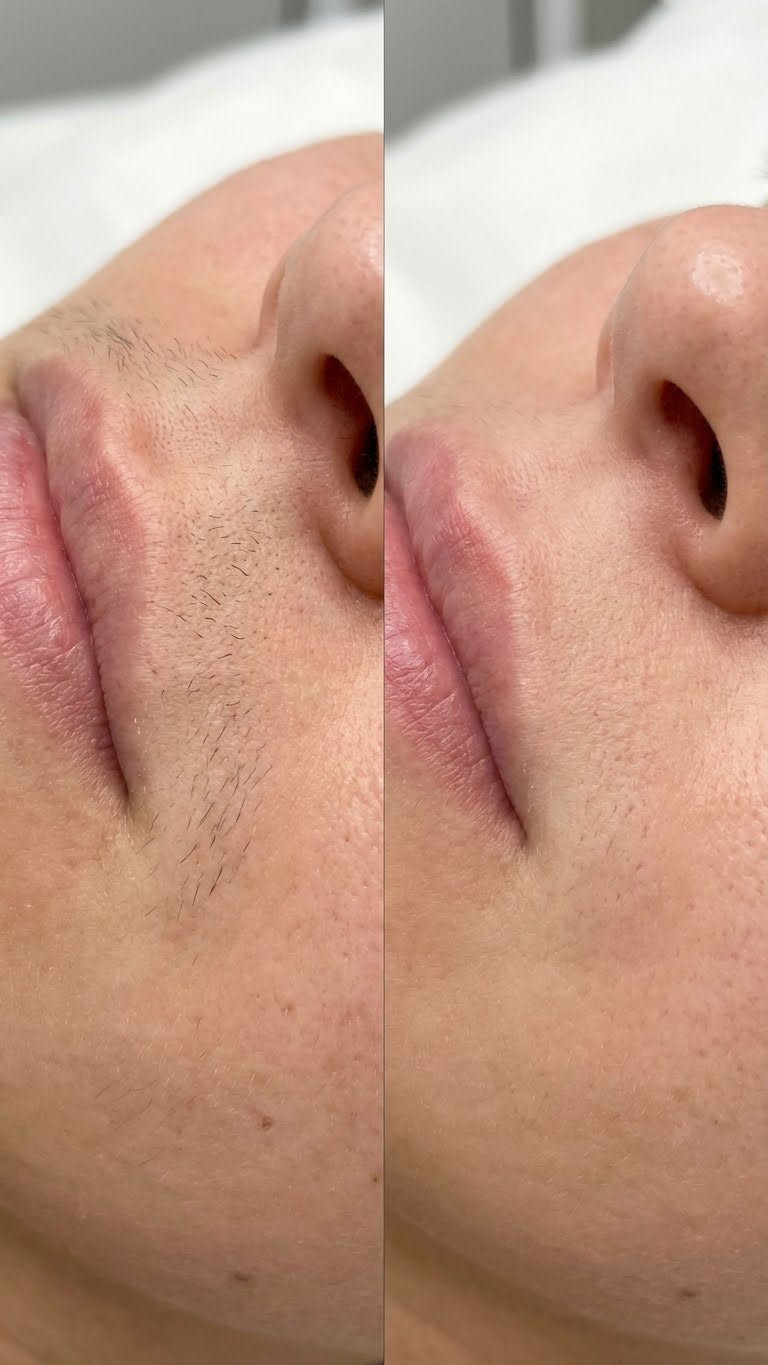 Laser Hair Removal  - Upper Lip