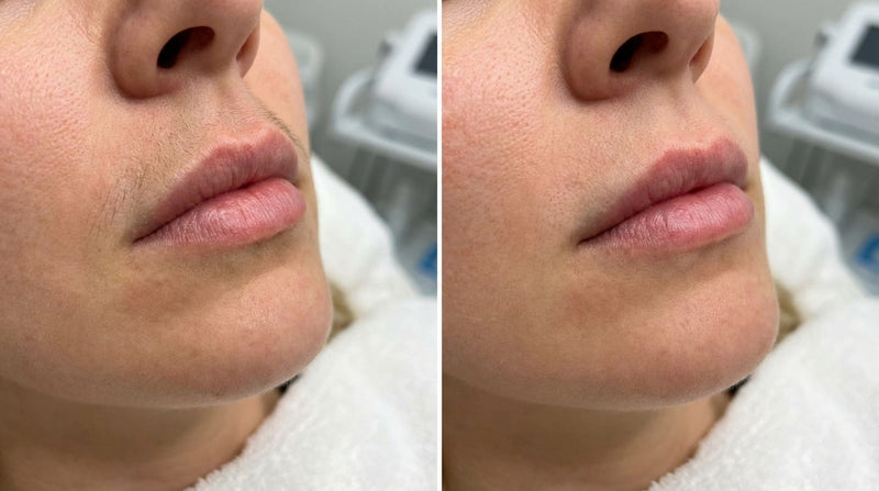Laser Hair Removal  - Upper Lip