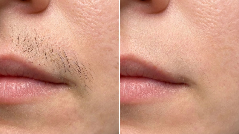 Laser Hair Removal  - Upper Lip