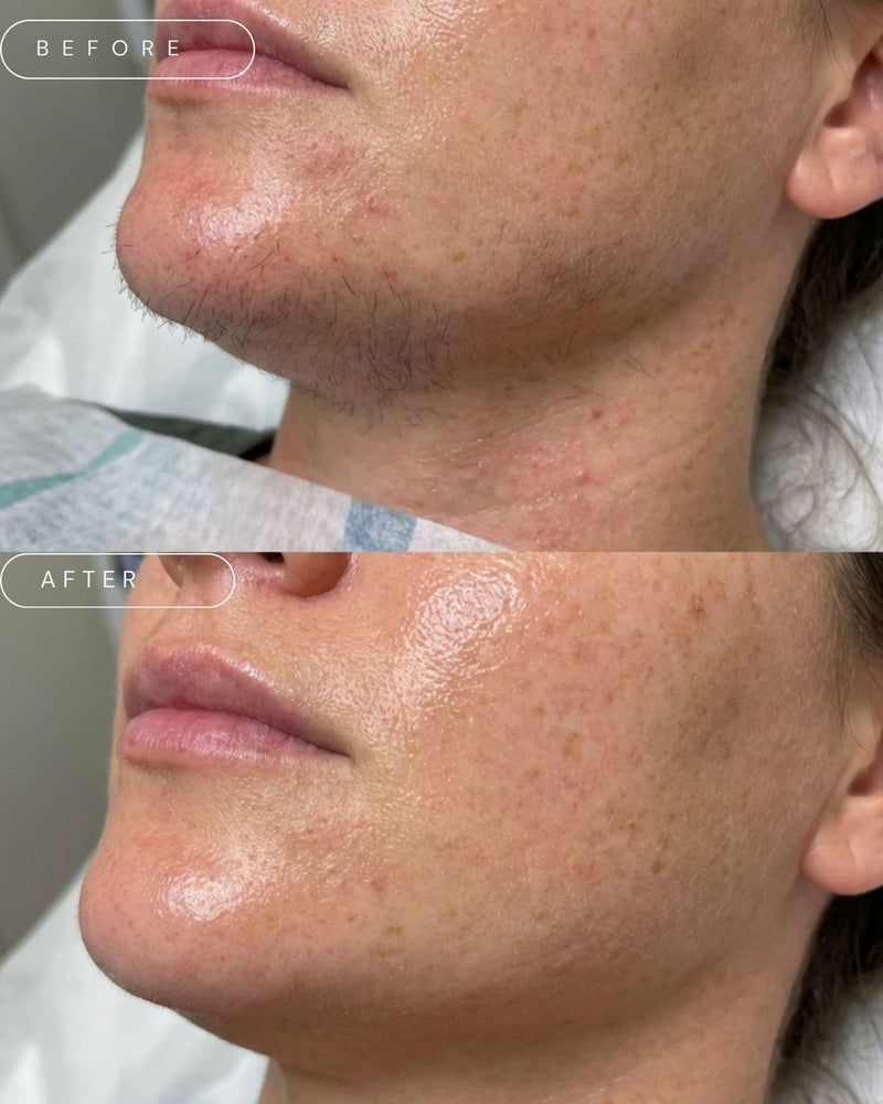 Laser Hair Removal Face - Nose